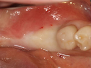 Dental implants before