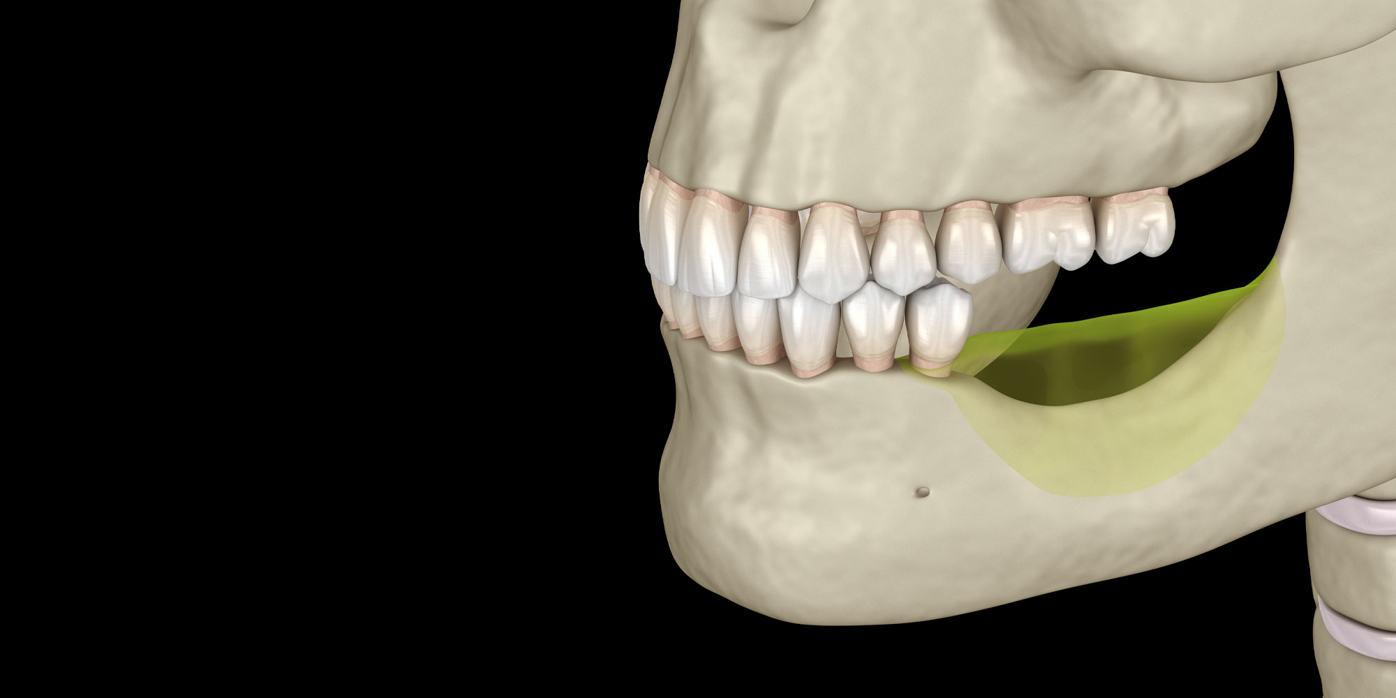 Illustration of bone loss in the jaw where teeth are missing
