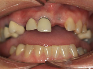 Dental implants before