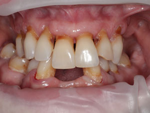 All-on-4® full arch before