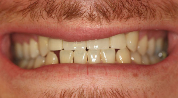 Dental implant & crowns after