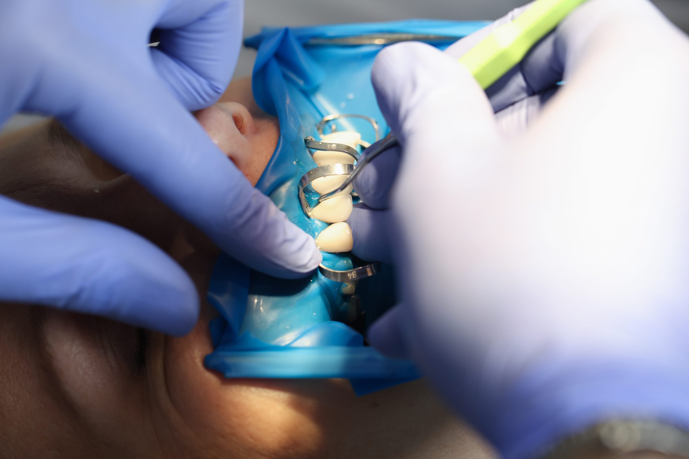 A porcelain crown being fitted