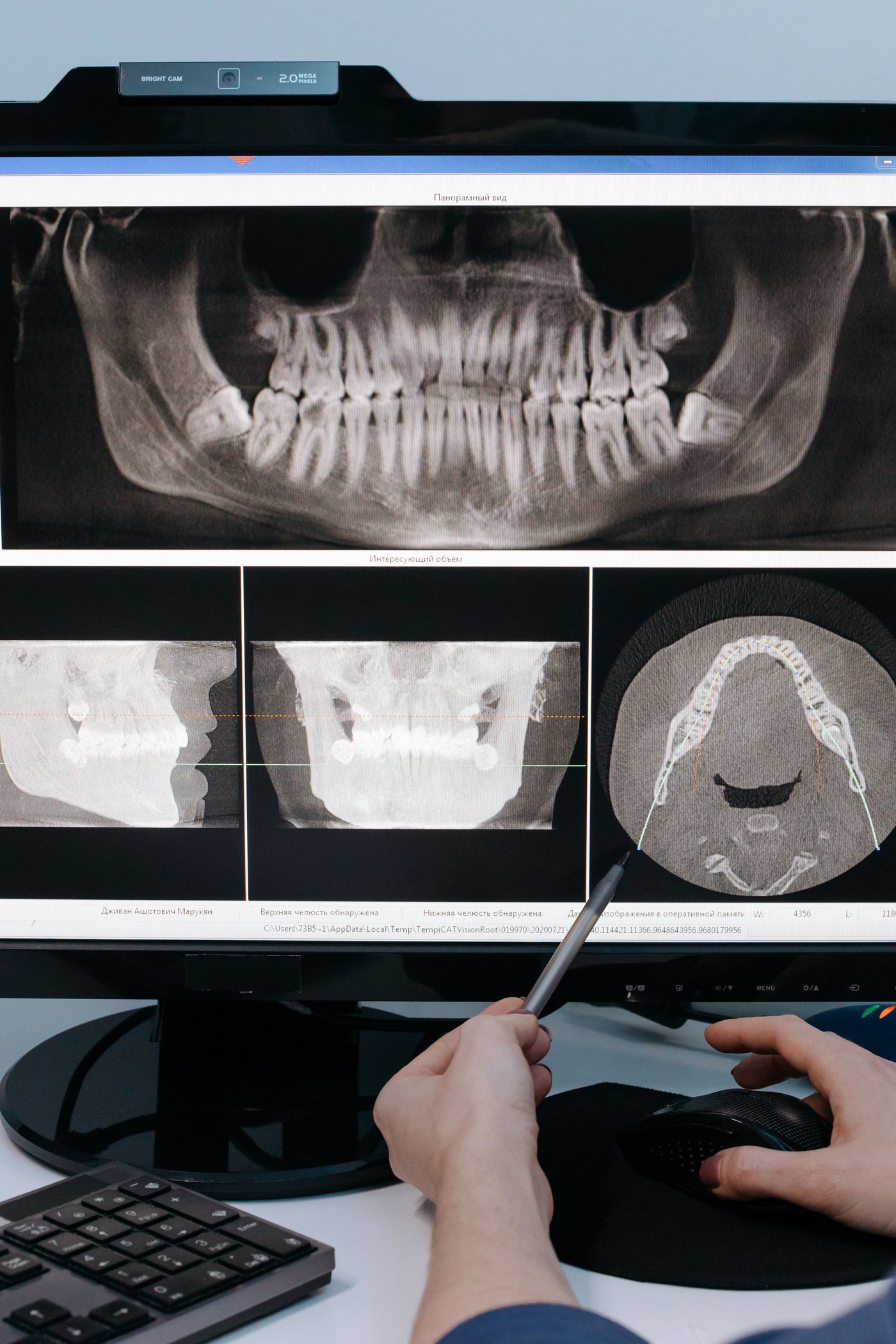 A cone-beam CT scan on screen, showing the jaw bone in panoramic and cross-section views