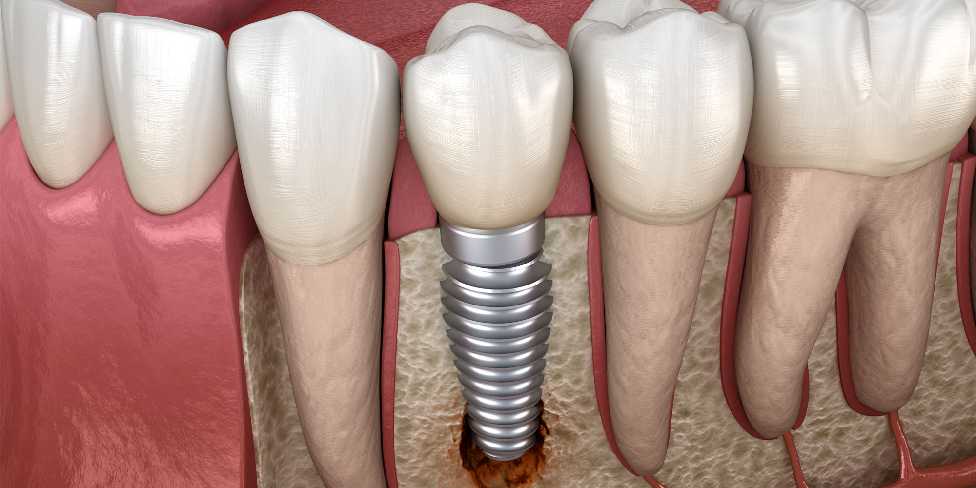 A model showing peri-implantitis around a dental implant