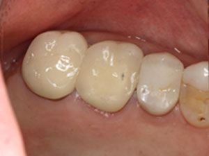 Dental implants after