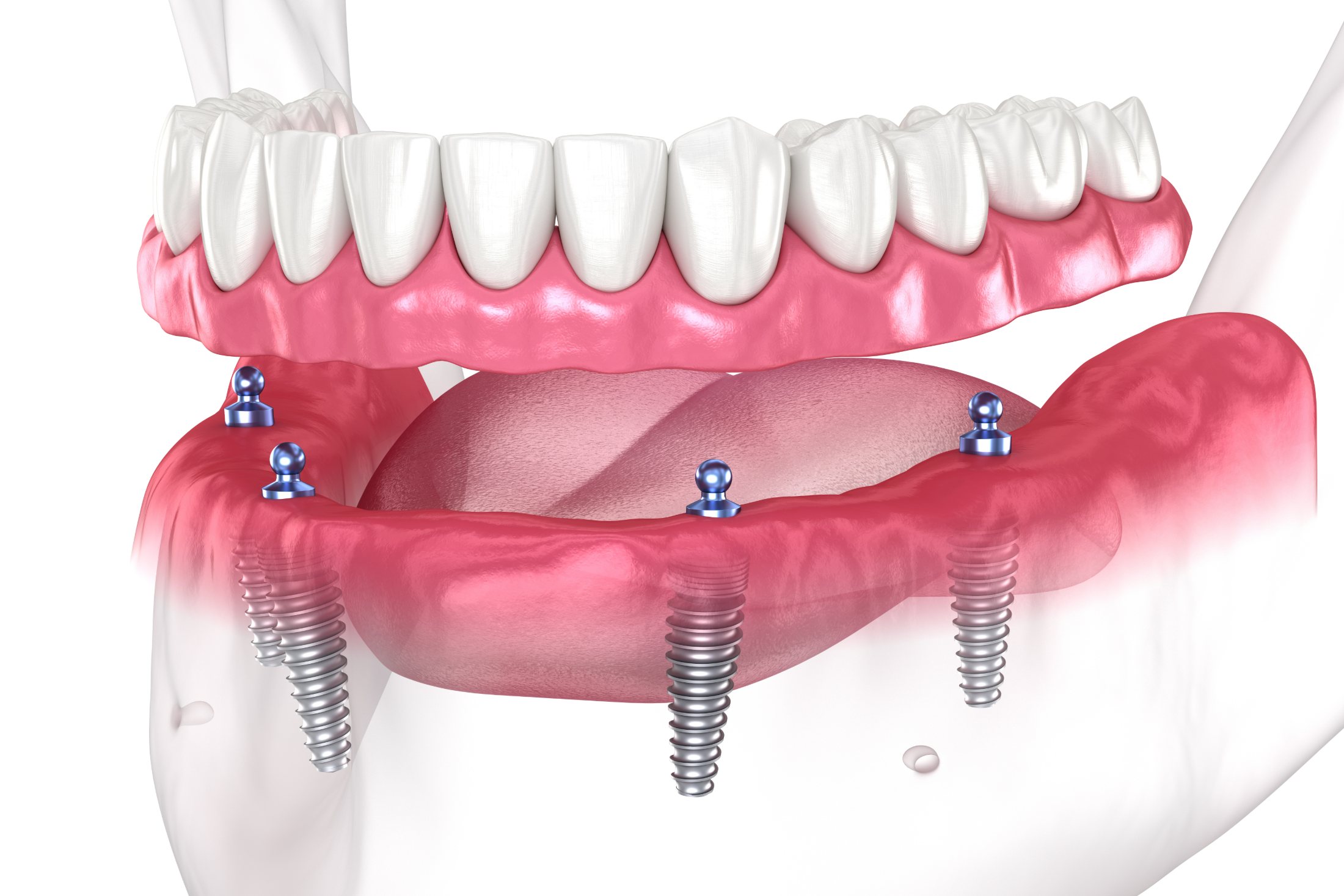 Illustration of a lower denture that clicks onto four implants