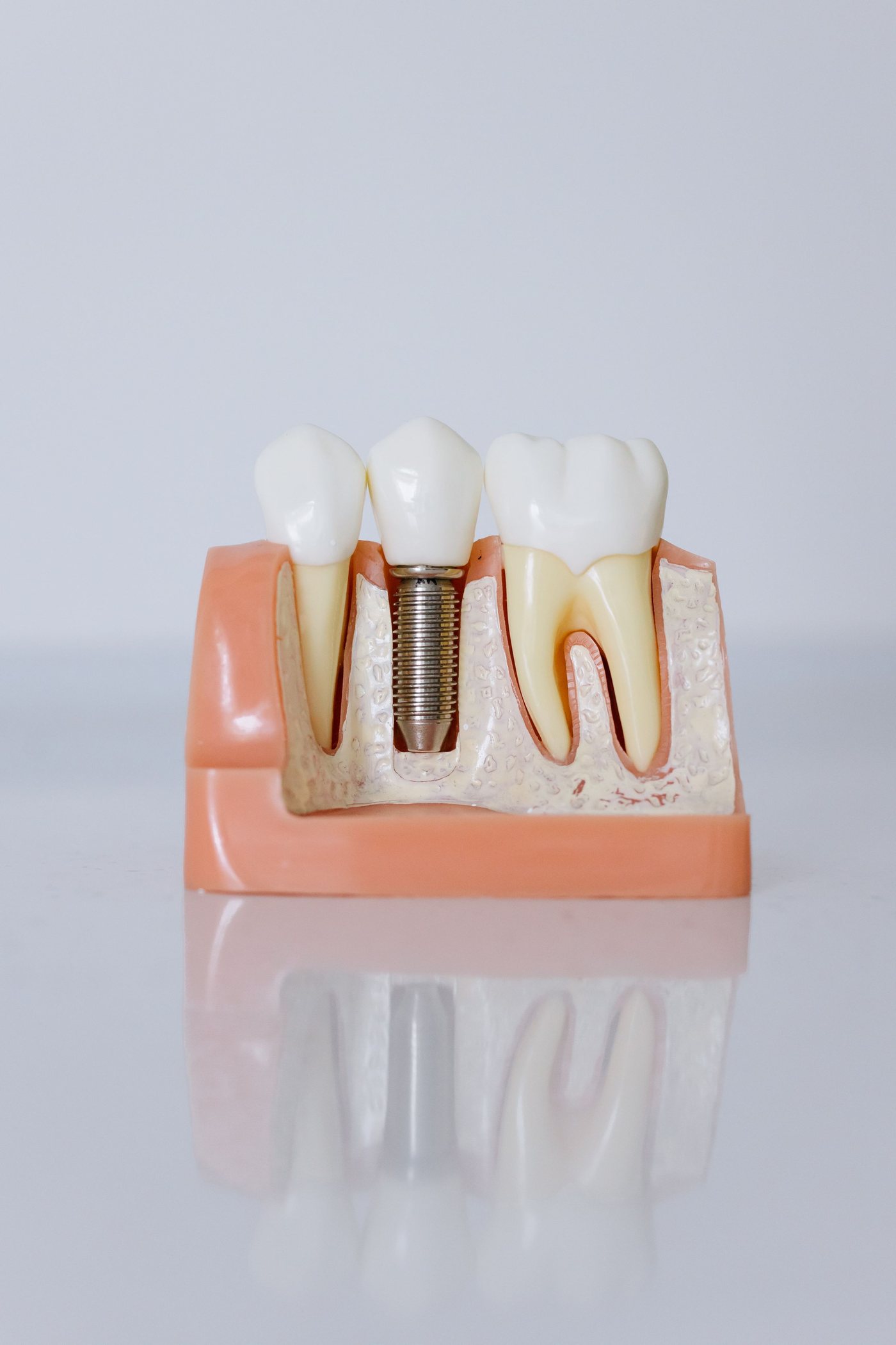 A model of a dental implant replacing a missing tooth between two natural teeth
