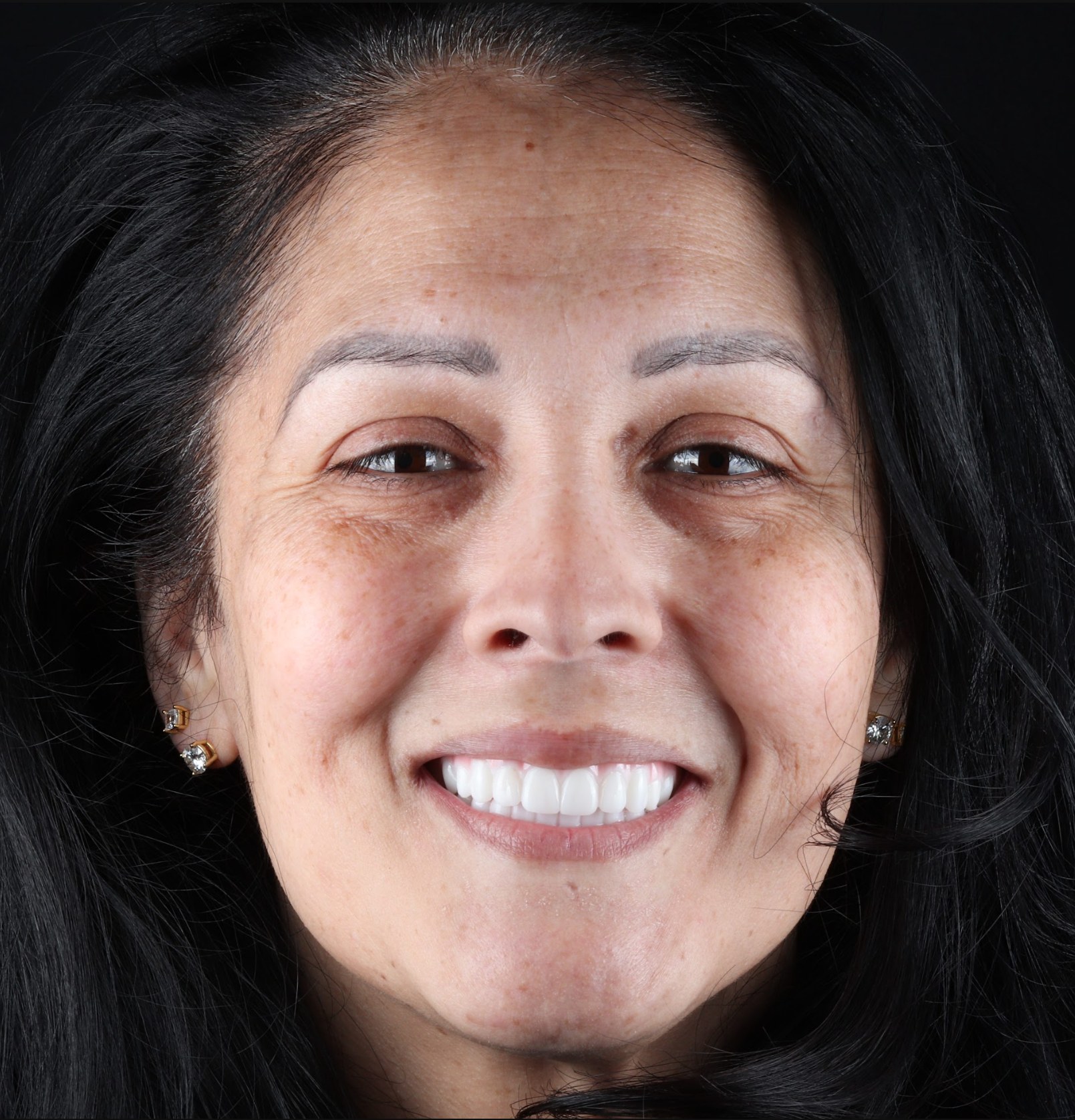 A West LA Implants patient smiling after her treatment