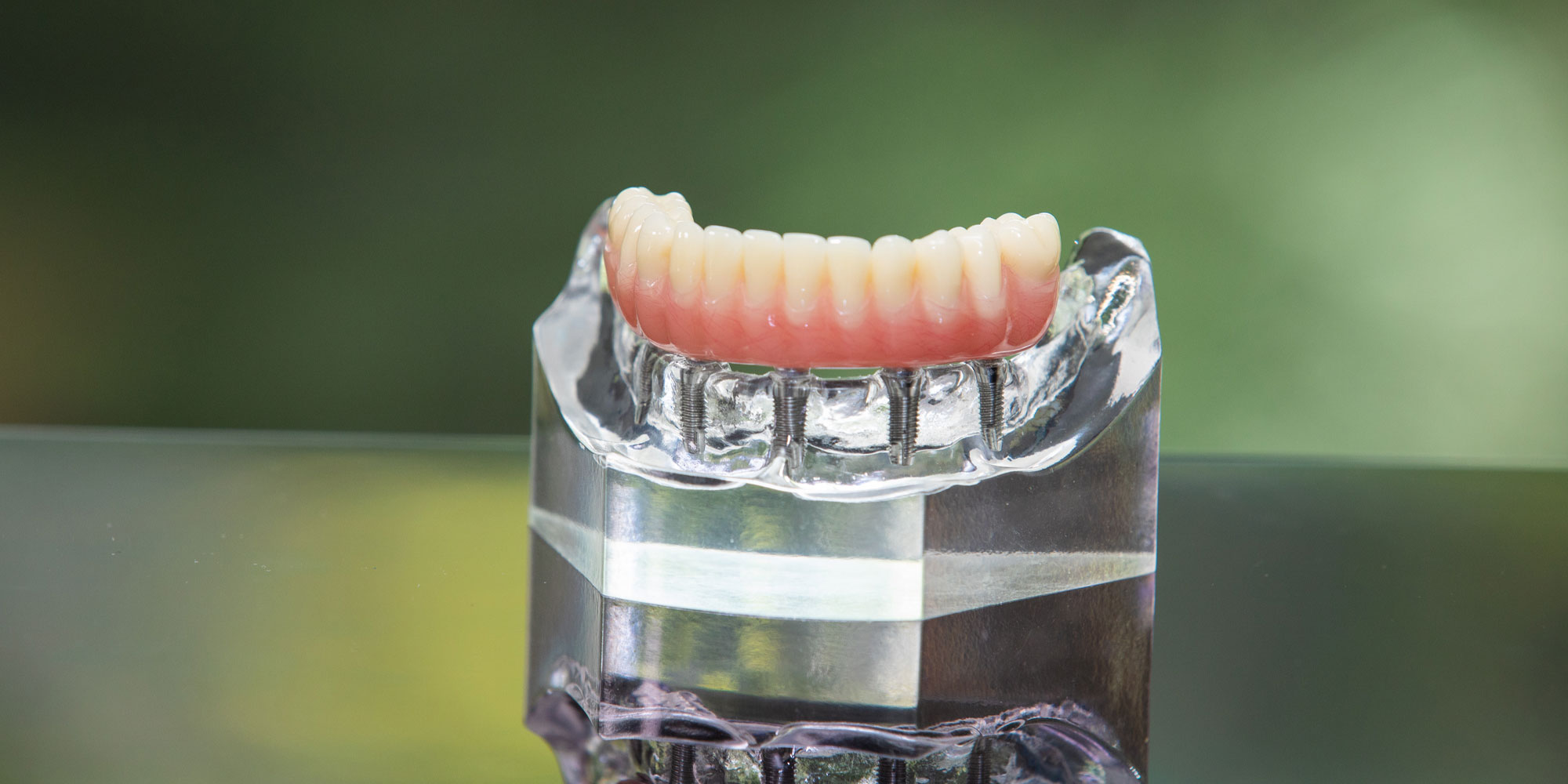 A full-arch bridge on four implants