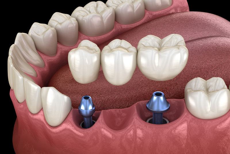 Two implants supporting a three-tooth bridge