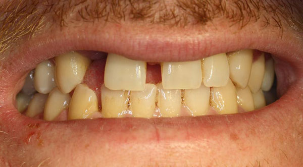 Dental implant & crowns before