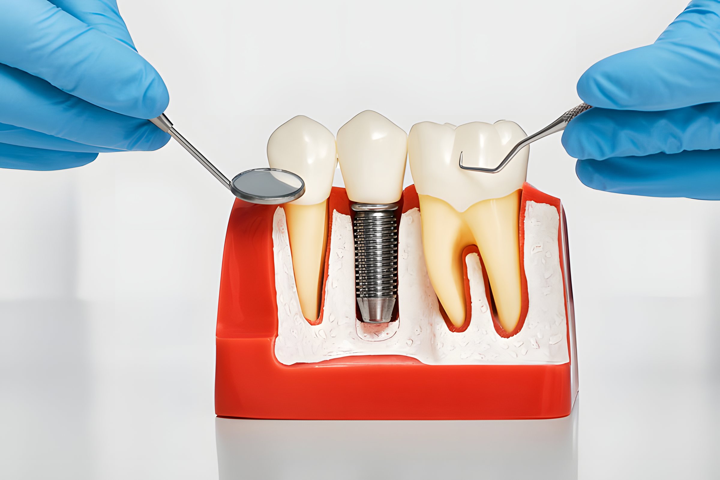 A model of a tooth and an implant standing in gum and bone