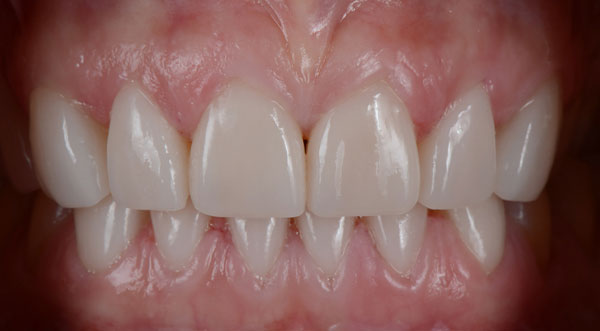 Teeth after porcelain veneers