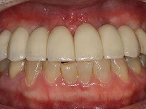 Dental implants after