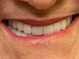 Implants & crowns after