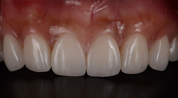 Upper teeth after porcelain veneers