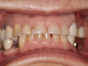 Implants & crowns before
