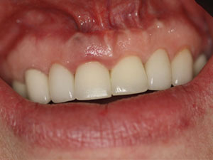 Dental implants after
