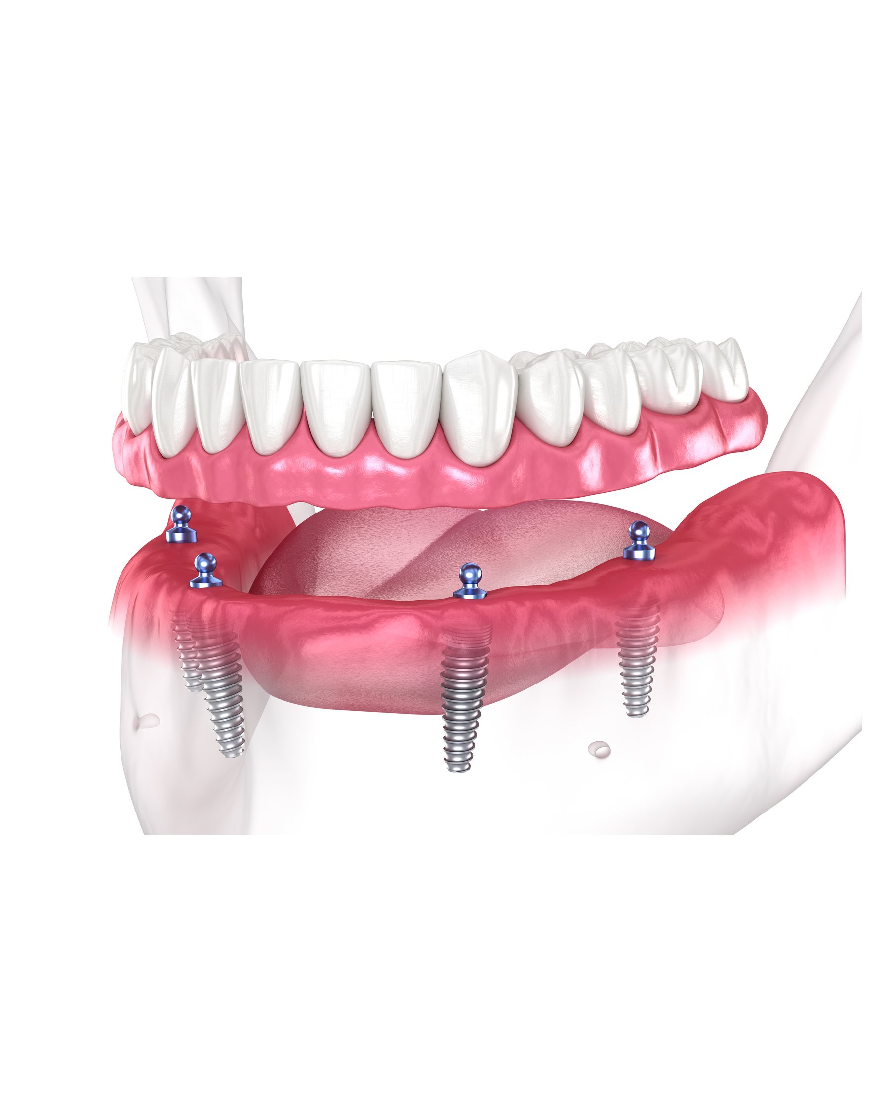 A model of a full arch of teeth fixed on four implants