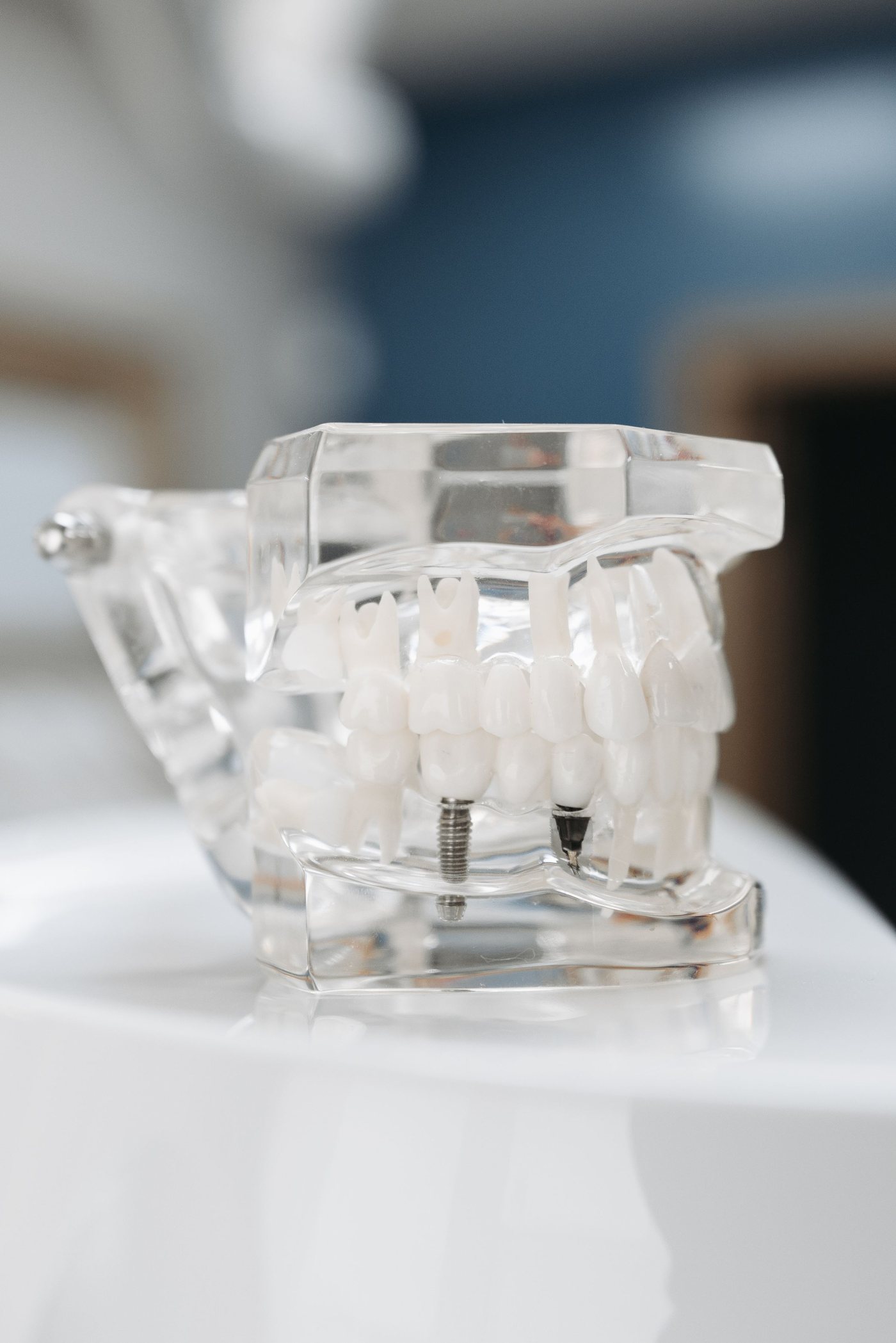 A clear jaw model with two implants holding a row of teeth
