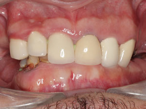 Full mouth reconstruction before