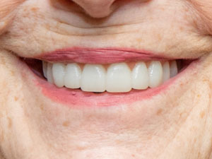 All-on-4® full arch after