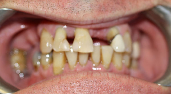 Dental implants before