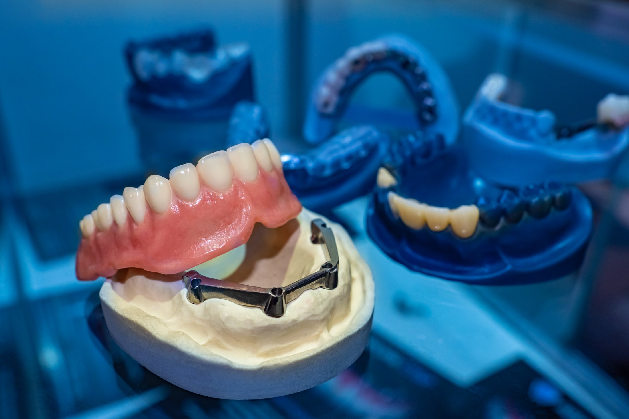 Model of a full-arch denture on a metal bar fixed to implants