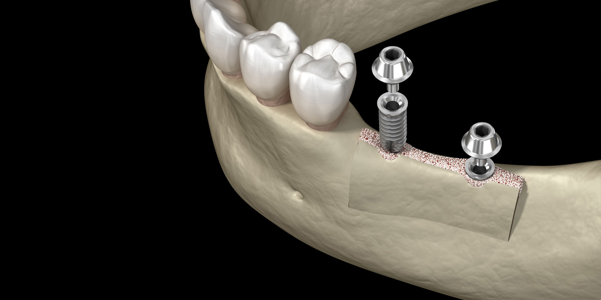 A 3D model of a ridge augmentation