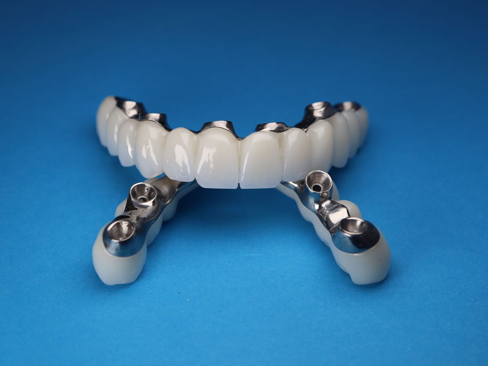 A full-arch implant bridge of ceramic teeth on a titanium framework